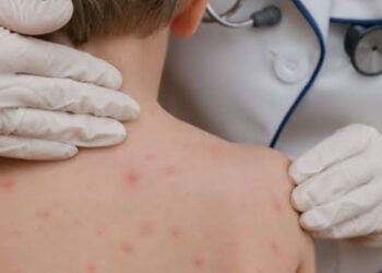 Descarta Salud casos activos de sarampión en Tamaulipas y confirma abasto de vacunas