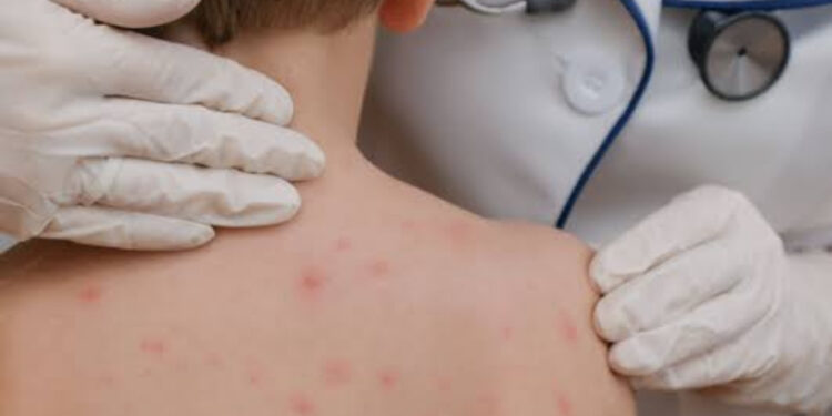 Descarta Salud casos activos de sarampión en Tamaulipas y confirma abasto de vacunas